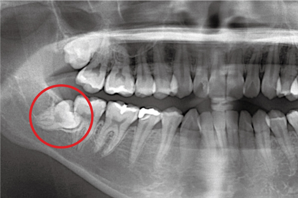 歯ぐきに埋もいる、隣の歯に向かって横に生えている親知らずの処置も可能です。
