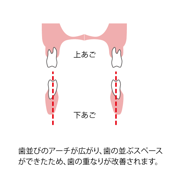 歯並びのアーチが広がり、歯の重なりが改善されます。