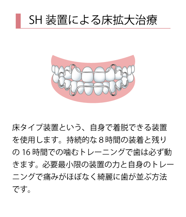 SH非抜歯矯正治療