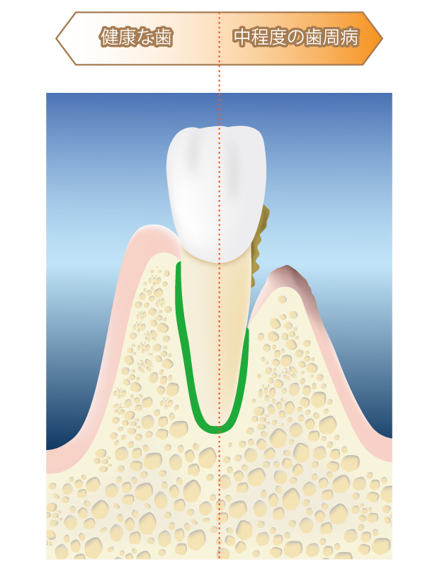 歯周病の歯の進行