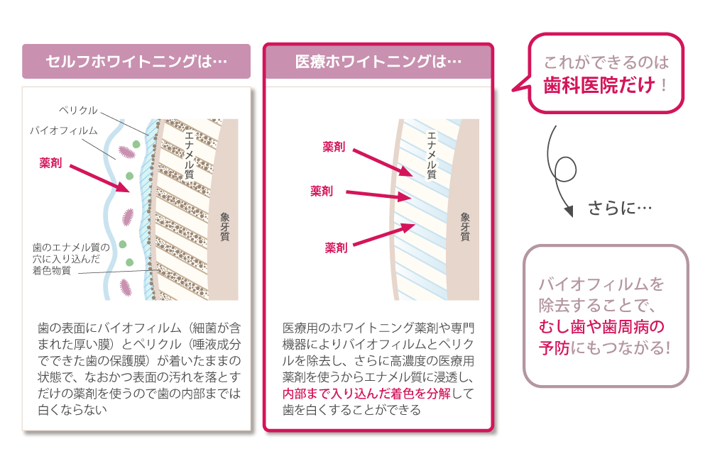 セルフホワイトニングと医療ホワイトニングの解説