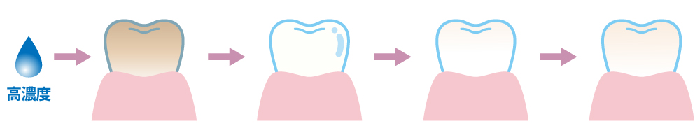 オフィスホワイトニングのシェード遷移イメージ