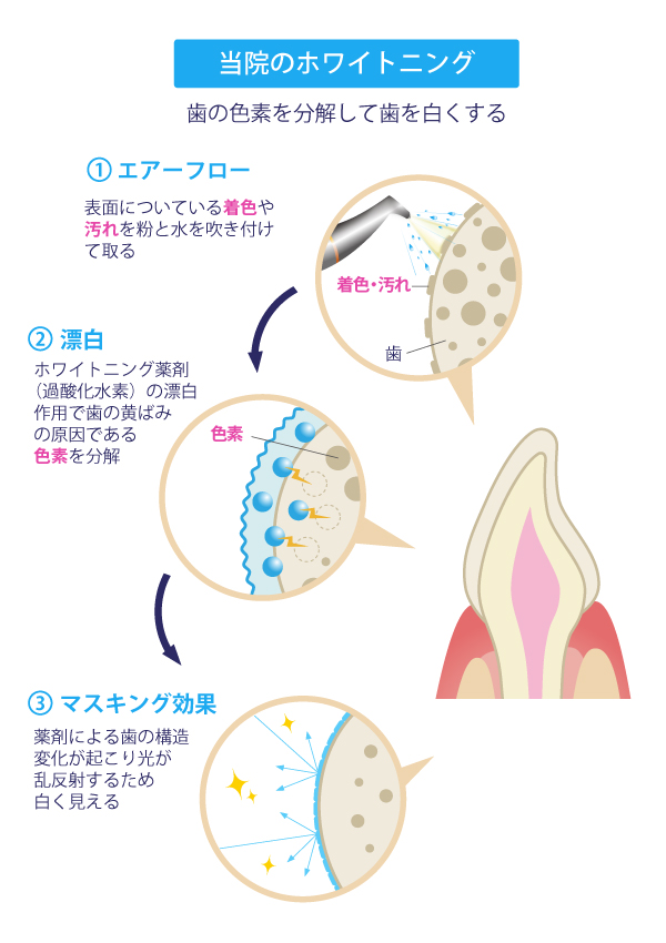 当院のホワイトニング